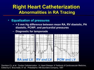Right Heart Catheterization
Abnormalities in RA Tracing
• Equalization of pressures
– < 5 mm Hg difference between mean RA, RV diastolic, PA
diastolic, PCWP, and pericardial pressures
– Diagnostic for tamponade
Davidson CJ, et al. Cardiac Catheterization. In: Heart Disease: A Textbook of Cardiovascular Medicine,
Edited by E. Braunwald, 5th
ed. Philadelphia: WB Saunders Company, 1997
RA and LV RV and LV PCW and LV
 