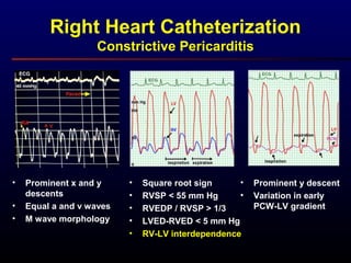 Right Heart Catheterization
Constrictive Pericarditis
• Prominent x and y
descents
• Equal a and v waves
• M wave morphology
• Square root sign
• RVSP < 55 mm Hg
• RVEDP / RVSP > 1/3
• LVED-RVED < 5 mm Hg
• RV-LV interdependence
• Prominent y descent
• Variation in early
PCW-LV gradient
 
