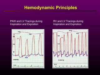 PAW and LV Tracings during
Inspiration and Expiration
RV and LV Tracings during
Inspiration and Expiration
Hemodynamic Principles
 