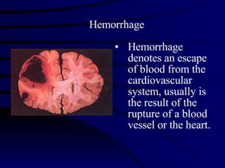 Hemorrhage Hemorrhage denotes an escape of blood from the cardiovascular system, usually is the result of the rupture of a blood vessel or the heart.  