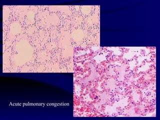 Acute pulmonary congestion 