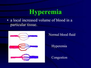 a local increased volume of blood in a particular tissue.  Hyperemia Normal blood fluid Hyperemia Congestion 