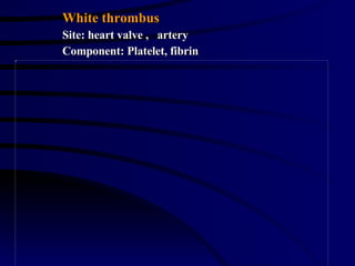 White thrombus Site: heart valve ,  artery Component: Platelet, fibrin 