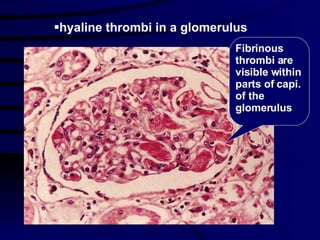 Fibrinous thrombi are visible within parts of capi. of the glomerulus hyaline thrombi in a glomerulus 