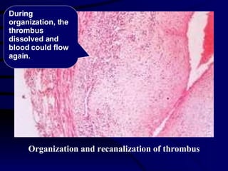 Organization and recanalization of thrombus During organization, the thrombus dissolved and blood could flow again. 