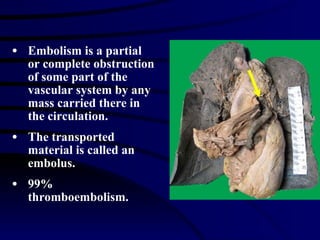Embolism is a partial or complete obstruction of some part of the vascular system by any mass carried there in the circulation. The transported material is called an embolus. 99% thromboembolism. 
