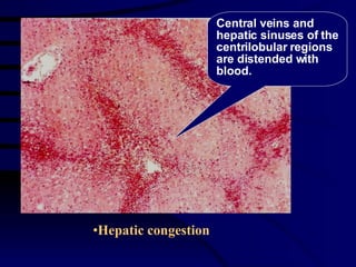 <ul><li>Hepatic congestion </li></ul>Central veins and hepatic sinuses of the centrilobular regions are distended with blo...
