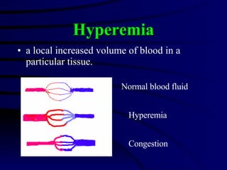 <ul><li>a local increased volume of blood in a particular tissue.  </li></ul>Hyperemia Normal blood fluid Hyperemia Conges...
