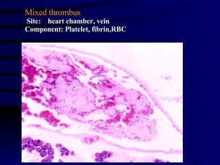 Mixed thrombus Site:  heart chamber, vein Component: Platelet, fibrin,RBC 