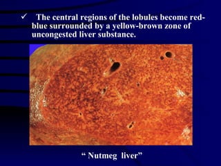 The central regions of the lobules become red-blue surrounded by a yellow-brown zone of uncongested liver substance. “  Nutmeg  liver” 