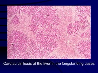 Cardiac cirrhosis of the liver in the longstanding cases 
