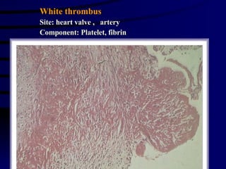 White thrombus Site: heart valve ,  artery Component: Platelet, fibrin 