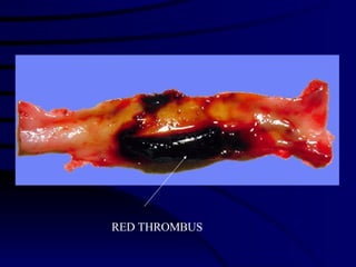 RED THROMBUS 