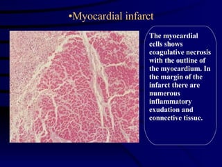 Myocardial infarct The myocardial cells shows coagulative necrosis with the outline of the myocardium. In the margin of the infarct there are numerous inflammatory exudation and connective tissue.  