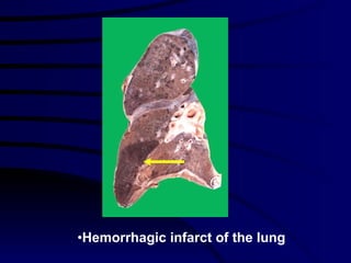 Hemorrhagic infarct of the lung 