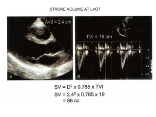 STROKE VOLUME AT LVOT
 