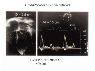 STROKE VOLUME AT MITRAL ANNULUS
 