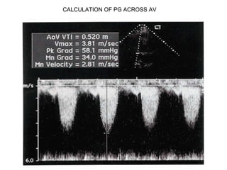 CALCULATION OF PG ACROSS AV
 