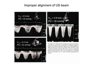 Improper alignment of US beam
 