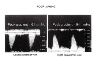 Apical 5 chamber view Right parasternal view
POOR IMAGING
 