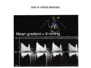 Use in mitral stenosis
 