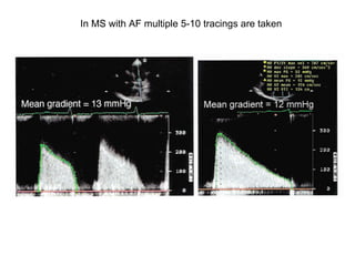 In MS with AF multiple 5-10 tracings are taken
 