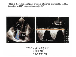 TR jet is the reflection of peak pressure difference between RV and RA
in systole and RA pressure is equal to JVP
 