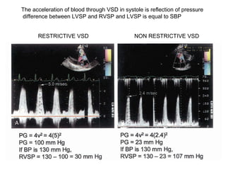 The acceleration of blood through VSD in systole is reflection of pressure
difference between LVSP and RVSP and LVSP is equal to SBP
RESTRICTIVE VSD NON RESTRICTIVE VSD
 