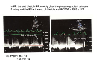 In PR, the end diastolic PR velocity gives the pressure gradient between
P artery and the RV at the end of diastole and RV EDP = RAP = JVP
So PADP= 18 + 10
= 28 mm Hg
 