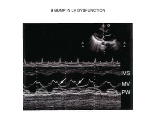 B BUMP IN LV DYSFUNCTION
 