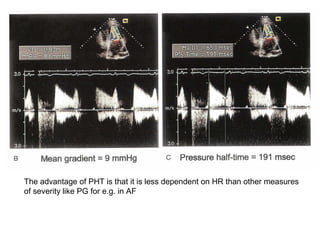 The advantage of PHT is that it is less dependent on HR than other measures
of severity like PG for e.g. in AF
 