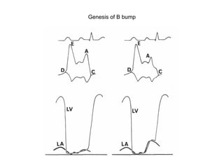 Genesis of B bump
 