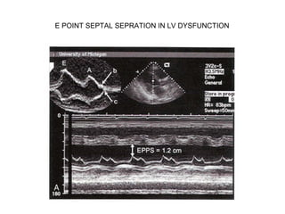 E POINT SEPTAL SEPRATION IN LV DYSFUNCTION
 