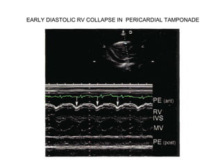 EARLY DIASTOLIC RV COLLAPSE IN PERICARDIAL TAMPONADE
 