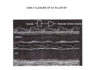 EARLY CLOSURE OF AV IN LOW EF
 