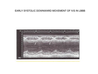 EARLY SYSTOLIC DOWNWARD MOVEMENT OF IVS IN LBBB
 