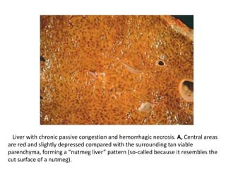 Liver with chronic passive congestion and hemorrhagic necrosis. A, Central areas
are red and slightly depressed compared with the surrounding tan viable
parenchyma, forming a “nutmeg liver” pattern (so-called because it resembles the
cut surface of a nutmeg).
 