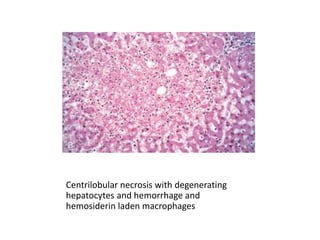 Centrilobular necrosis with degenerating
hepatocytes and hemorrhage and
hemosiderin laden macrophages
 