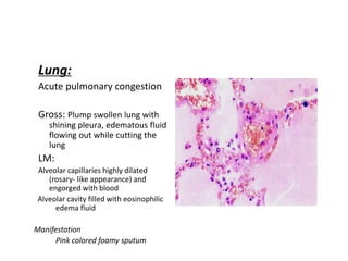Lung:
Acute pulmonary congestion
Gross: Plump swollen lung with
shining pleura, edematous fluid
flowing out while cutting the
lung
LM:
Alveolar capillaries highly dilated
(rosary- like appearance) and
engorged with blood
Alveolar cavity filled with eosinophilic
edema fluid
Manifestation
Pink colored foamy sputum
 