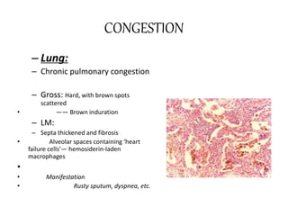 CONGESTION
– Lung:
– Chronic pulmonary congestion
– Gross: Hard, with brown spots
scattered
• —— Brown induration
– LM:
– Septa thickened and fibrosis
• Alveolar spaces containing ‘heart
failure cells’— hemosiderin-laden
macrophages
•
• Manifestation
• Rusty sputum, dyspnea, etc.
 