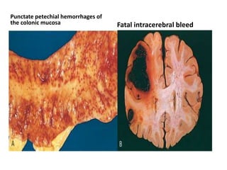 Punctate petechial hemorrhages of
the colonic mucosa Fatal intracerebral bleed
 