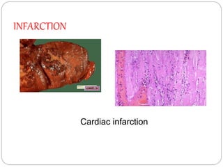 Hemodynamic disorders | PPTX