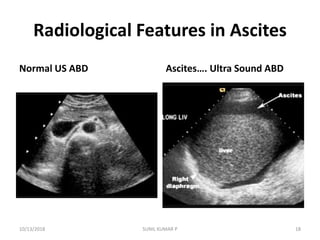 Radiological Features in Ascites
Normal US ABD Ascites…. Ultra Sound ABD
10/13/2018 SUNIL KUMAR P 18
 