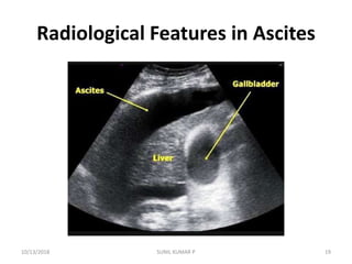 Radiological Features in Ascites
10/13/2018 SUNIL KUMAR P 19
 