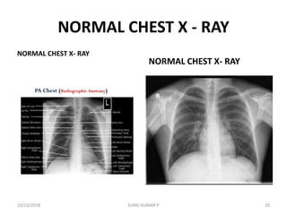 NORMAL CHEST X - RAY
NORMAL CHEST X- RAY
NORMAL CHEST X- RAY
10/13/2018 SUNIL KUMAR P 20
 