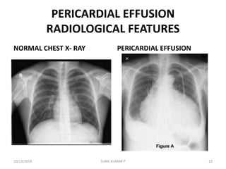 PERICARDIAL EFFUSION
RADIOLOGICAL FEATURES
NORMAL CHEST X- RAY PERICARDIAL EFFUSION
10/13/2018 SUNIL KUMAR P 23
 