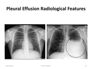 Pleural Effusion Radiological Features
10/13/2018 SUNIL KUMAR P 26
 