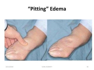 “Pitting” Edema
10/13/2018 46SUNIL KUMAR P
 