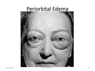 Periorbital Edema
10/13/2018 47SUNIL KUMAR P
 