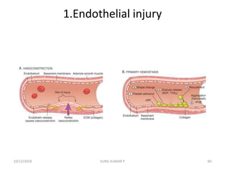 1.Endothelial injury
10/13/2018 60SUNIL KUMAR P
 